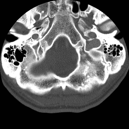 Cervical Pott disease (Radiopaedia 20374-20286 Axial bone window 4).jpg