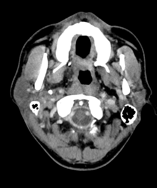 Cervical abscess (Radiopaedia 43725-47184 A 13).png