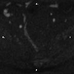 Cervical adenocarcinoma (Radiopaedia 65011-73985 Axial DWI 72).jpg