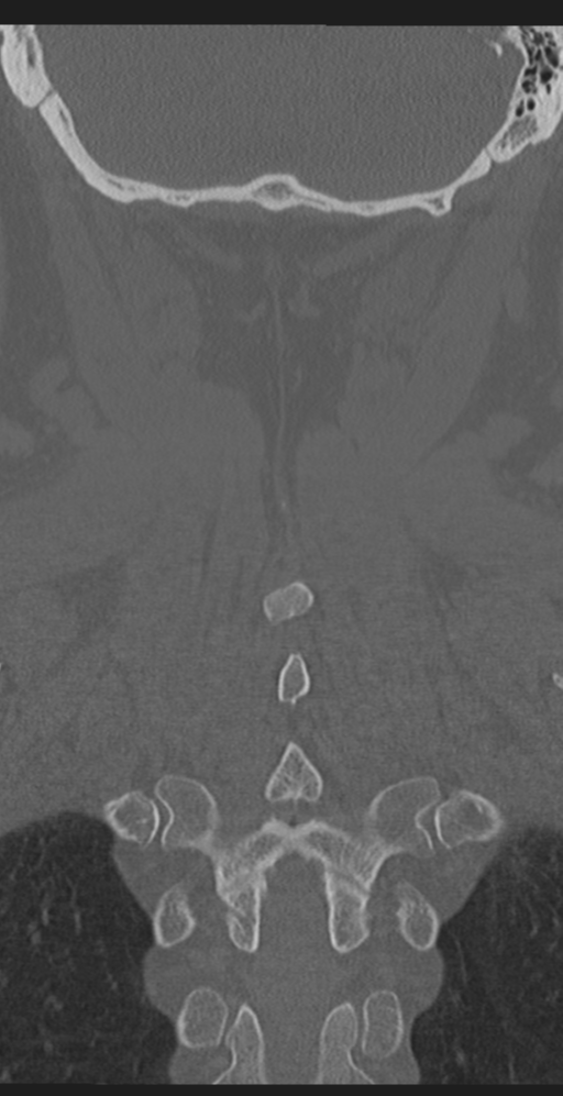 Cervical canal stenosis due to ossification of the posterior longitudinal ligament (Radiopaedia 47260-51823 Coronal bone window 52).png