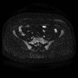File:Cervical carcinoma (Radiopaedia 67644-77047 Axial DWI 4).jpg