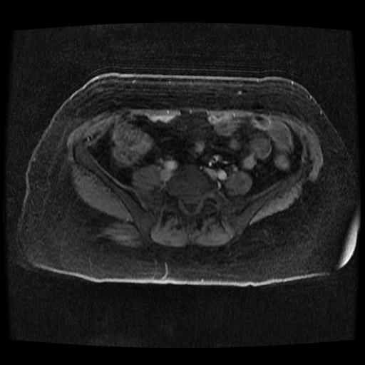 Cervical carcinoma (Radiopaedia 70924-81132 Axial T1 C+ fat sat 169).jpg
