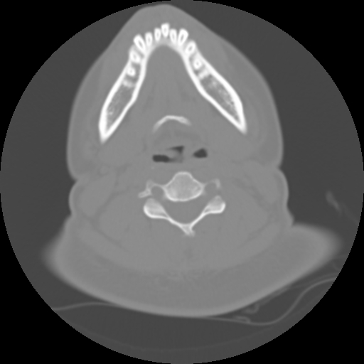 Cervical rib (Radiopaedia 71110-81363 Axial non-contrast 31).jpg