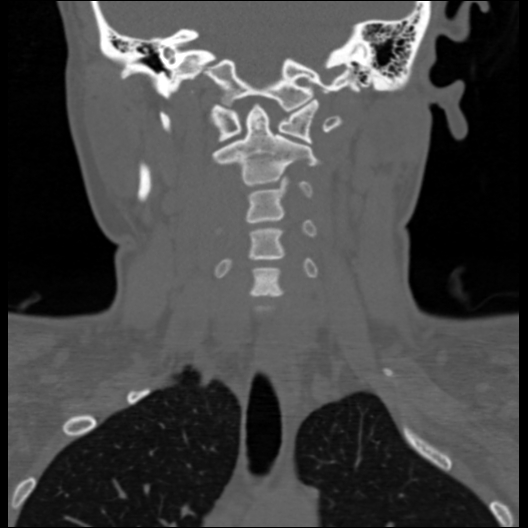 File:Cervical rib (Radiopaedia 71110-81363 Coronal non-contrast 29).jpg