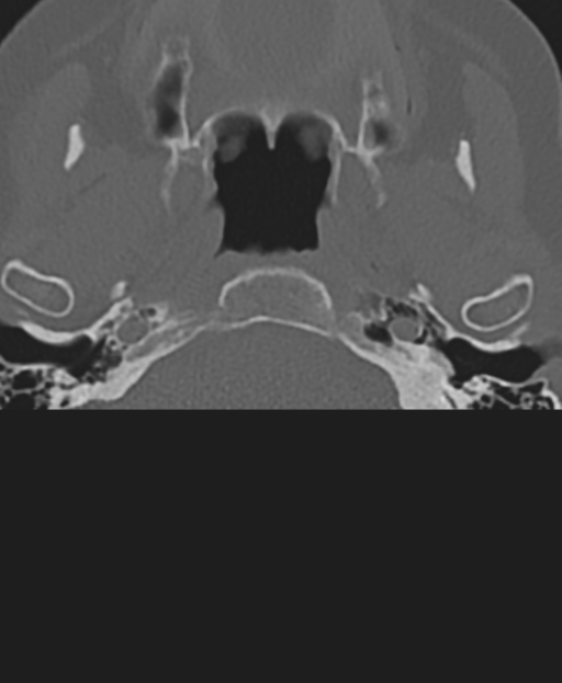 Cervical spine ACDF loosening (Radiopaedia 48998-54071 Axial bone window 4).png