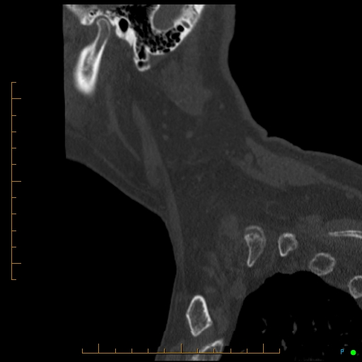 File:Cervical spine fracture - ankylosing spondylitis (Radiopaedia 76835-88706 Sagittal bone window 11).jpg