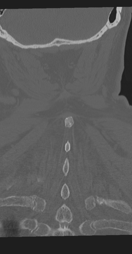 Cervical spine fracture in the setting of ankylosis (Radiopaedia 37038-38715 Coronal bone window 61).png