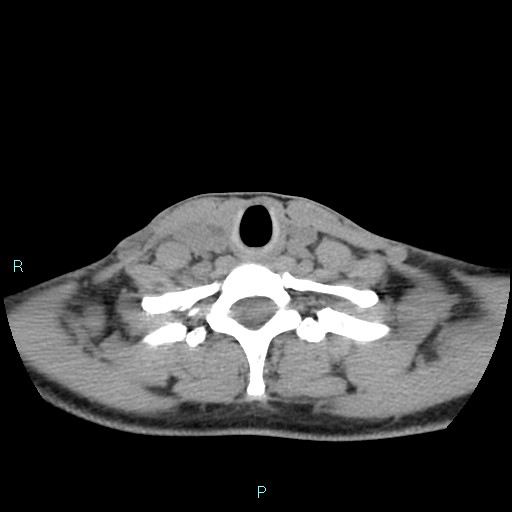 Cervical thymic cyst (Radiopaedia 88632-105335 Axial non-contrast 39).jpg