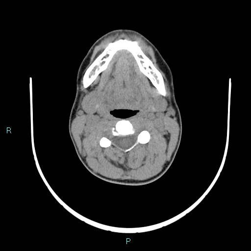 Cervical thymic cyst (Radiopaedia 88632-105335 Axial non-contrast 74).jpg