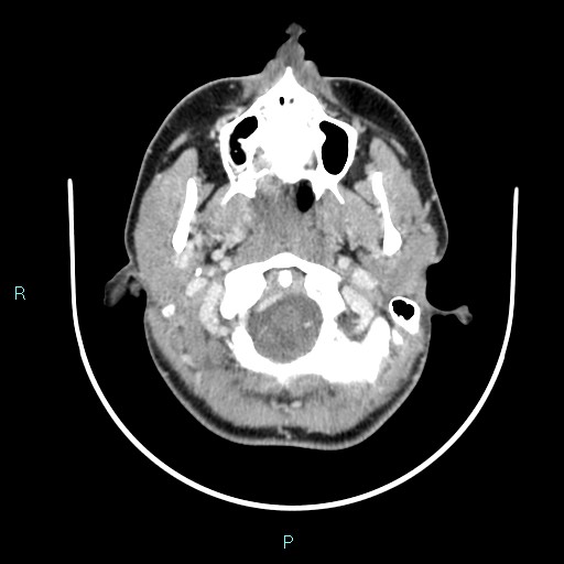 Cervical thymic cyst (Radiopaedia 88632-105335 C 99).jpg