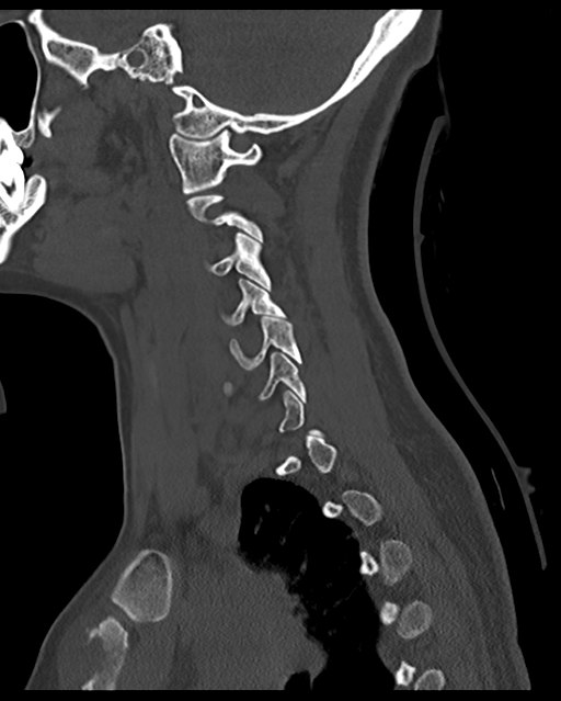 Cervical tuberculous spondylitis (Radiopaedia 39149-41365 Sagittal bone window 49).png