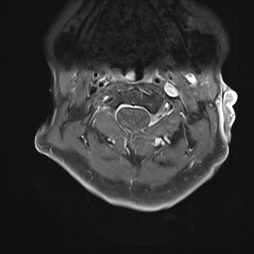 File:Cervical tumor-like myelopathy due to Type V dAVF (Radiopaedia 82461-96604 Axial T1 C+ fat sat 8).jpg