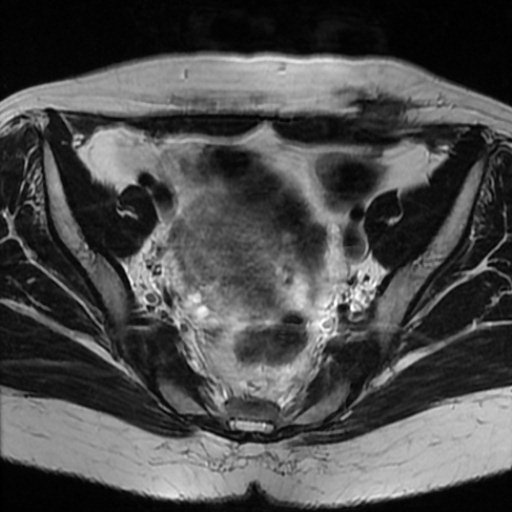 File:Cesarian section scar endometriosis (Radiopaedia 66520-75799 Axial T2 8).jpg