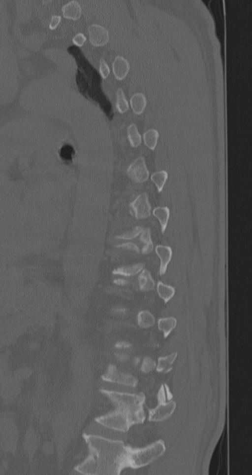 Chance fracture (Radiopaedia 33854-35020 Sagittal bone window 30).png