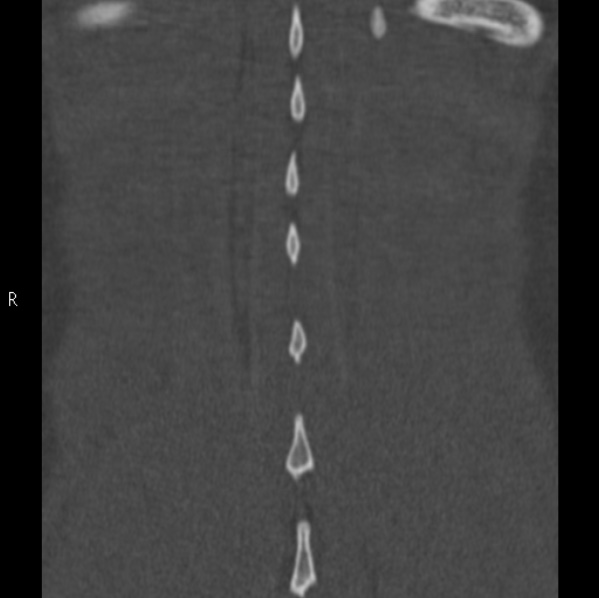 Chance fracture (Radiopaedia 36521-38081 Coronal bone window 62).jpg
