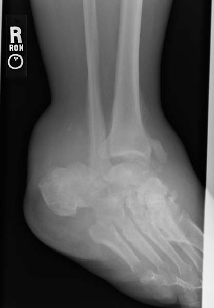 File:Charcot joint (Radiopaedia 11294-11658 Oblique 1).jpg