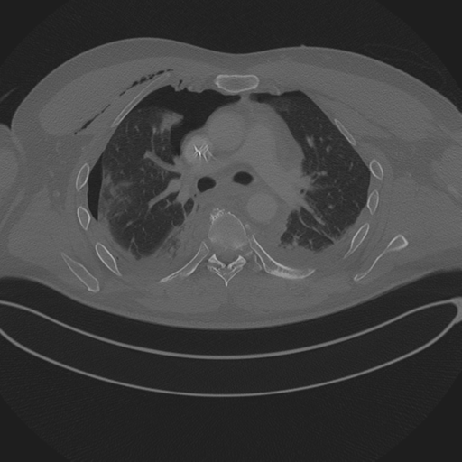 Chest multitrauma - aortic injury (Radiopaedia 34708-36147 Axial bone window 124).png