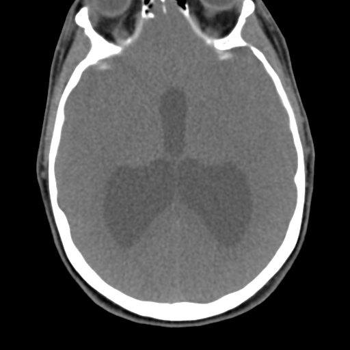 Chiari I malformation and obstructive hydrocephalus (Radiopaedia 41185-43981 D 12).png