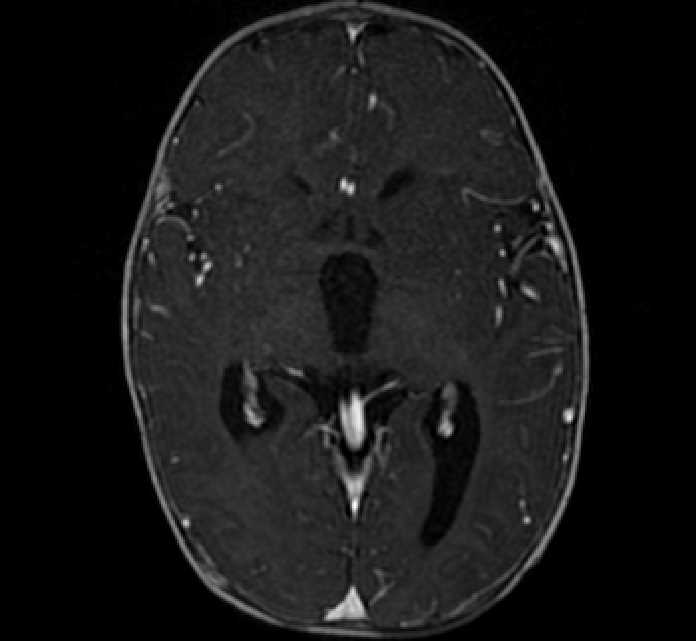 Chiasmatic-hypothalamic glioma (Radiopaedia 90079-107252 Axial T1 C+ 41).jpg
