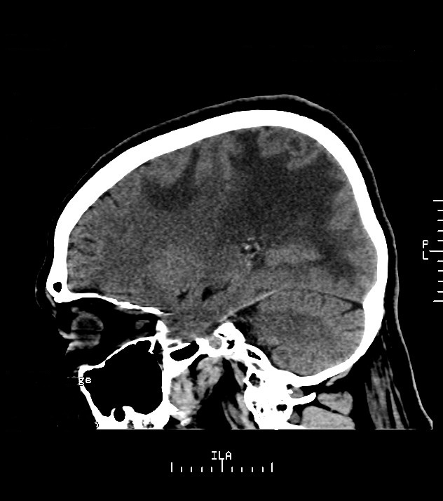 Cholangiocarcinoma with cerebral metastases (Radiopaedia 83519-98628 C 19).jpg