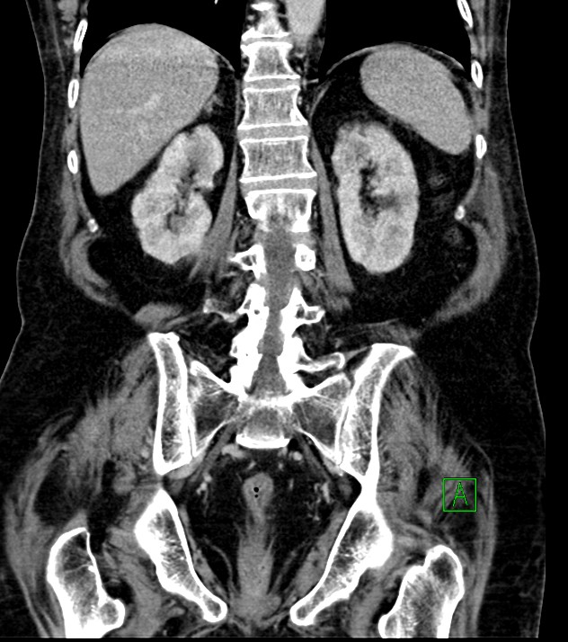 Cholangiocarcinoma with cerebral metastases (Radiopaedia 83519-98629 G 58).jpg