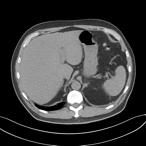Cholecystitis with focal perforation and hepatic abscess (Radiopaedia 37189-38945 Axial non-contrast 18).png