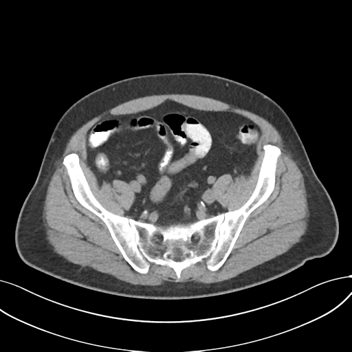 File:Cholecystitis with focal perforation and hepatic abscess (Radiopaedia 37189-38945 Axial non-contrast 67).png