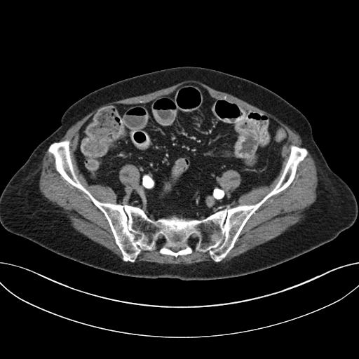 Cholecystoduodenal fistula due to calculous cholecystitis with gallstone migration (Radiopaedia 86875-103077 A 53).jpg