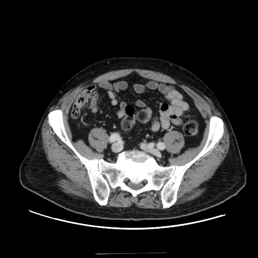 Choledocholiathiasis with normal caliber common bile duct (Radiopaedia 75368-86632 A 141).jpg