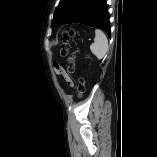 Choledocholiathiasis with normal caliber common bile duct (Radiopaedia 75368-86632 D 128).jpg
