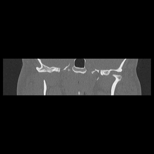 Cholesteatoma (Radiopaedia 84946-100455 Coronal bone window 81).jpg