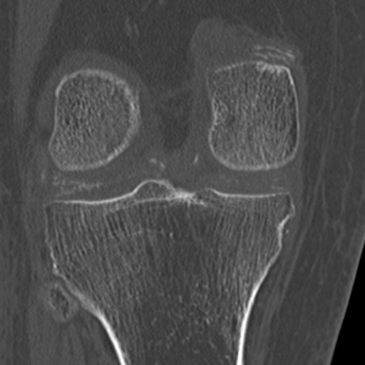 Chondrocalcinosis (Radiopaedia 16275-15955 Coronal bone window 39).jpg