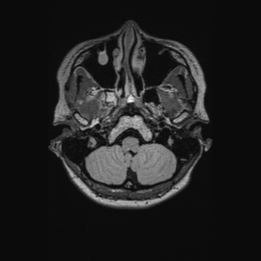 Chondrosarcoma (Radiopaedia 41937-44939 Axial FLAIR 21).png