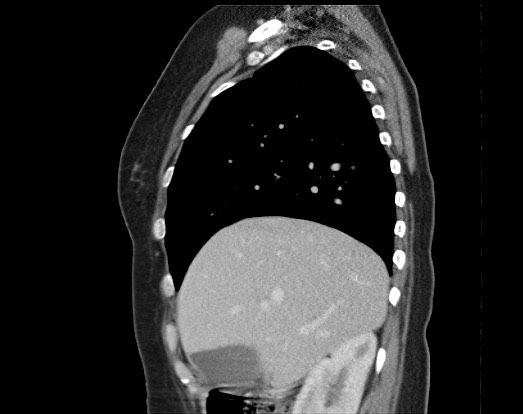 Chondrosarcoma - chest wall (Radiopaedia 65192-74199 B 43).jpg