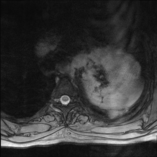 File:Chondrosarcoma - chest wall (Radiopaedia 65192-74200 Axial Gradient Echo 28).jpg
