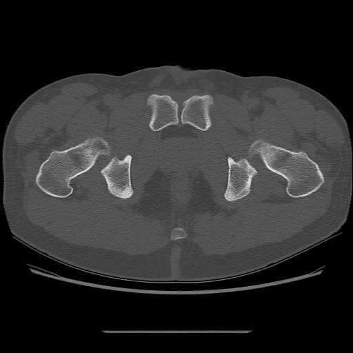 File:Chondrosarcoma of iliac wing (Radiopaedia 63861-72599 Axial bone window 114).jpg