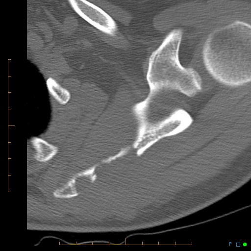 File:Chondrosarcoma of the scapula (Radiopaedia 30696-31399 Axial non-contrast 8).jpg