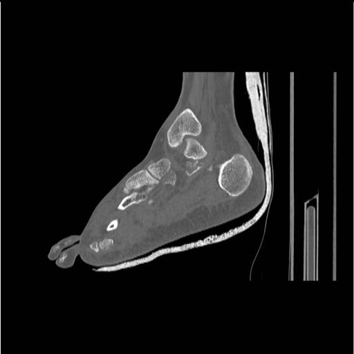 File:Chopart fracture (Radiopaedia 12386-12650 Sagittal bone window 24).jpg