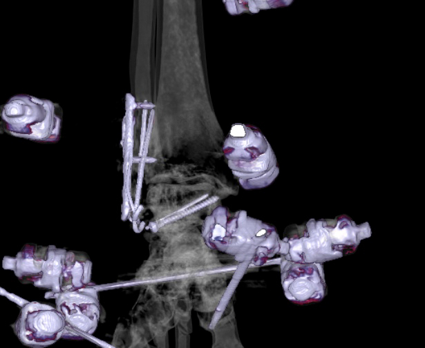 File:Chopart fracture (Radiopaedia 35347-36861 3D MPR bone window 19).jpg