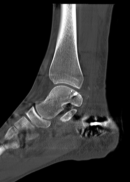 Chopart fracture (Radiopaedia 35347-36861 Sagittal bone window 38).jpg