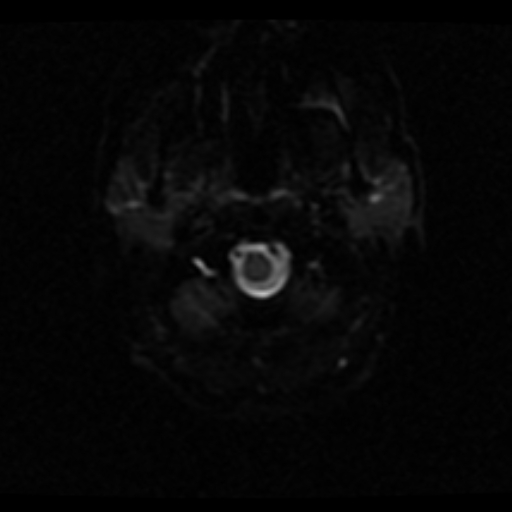 File:Choroid plexus xanthogranuloma (Radiopaedia 17650-17386 ADC 23).jpg