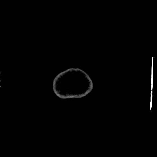 File:Choroid plexus xanthogranulomas (Radiopaedia 51621-57408 Axial non-contrast 122).jpg