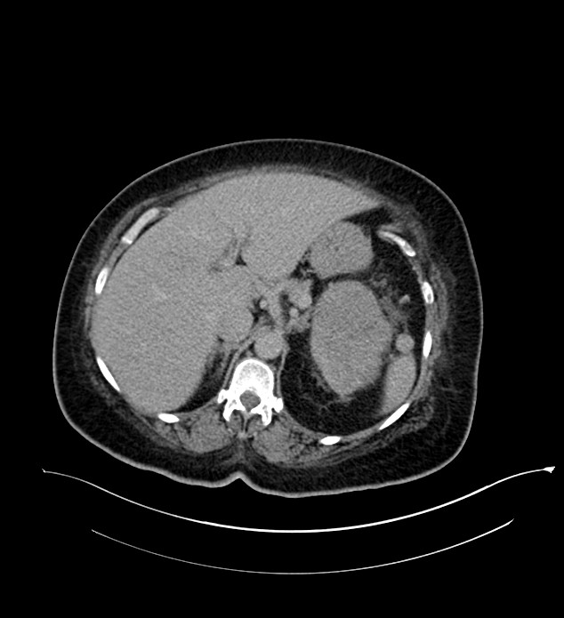 Chromophobe renal cell carcinoma (Radiopaedia 84239-99519 E 53).jpg