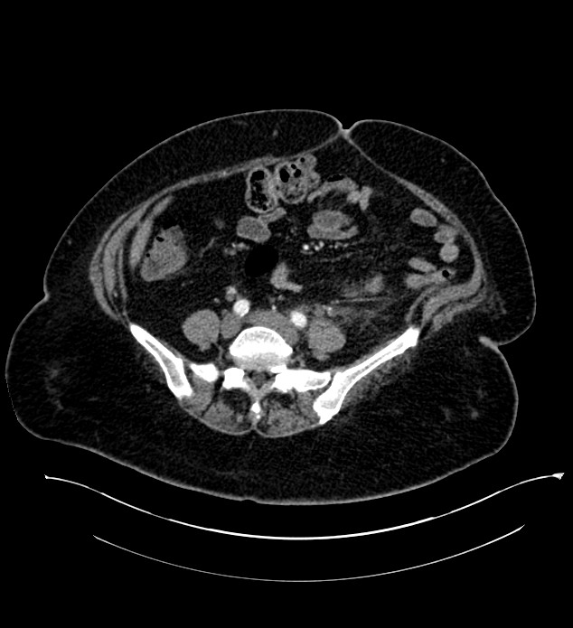 Chromophobe renal cell carcinoma (Radiopaedia 84255-99542 F 2).jpg