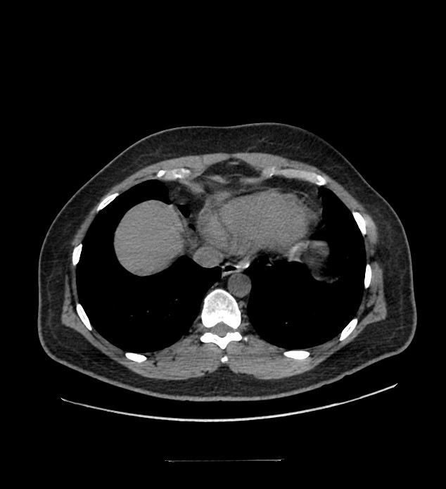 Chromophobe renal cell carcinoma (Radiopaedia 84337-99644 Axial non-contrast 5).jpg