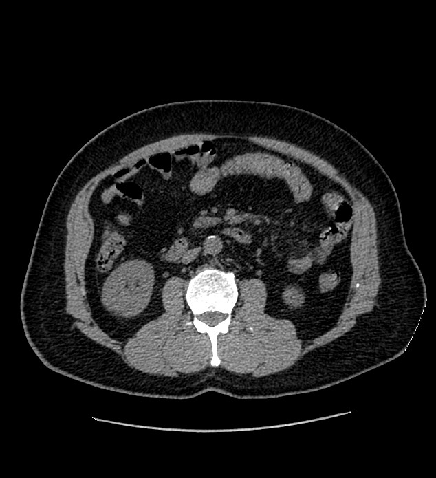 Chromophobe renal cell carcinoma (Radiopaedia 84337-99693 Axial non-contrast 65).jpg
