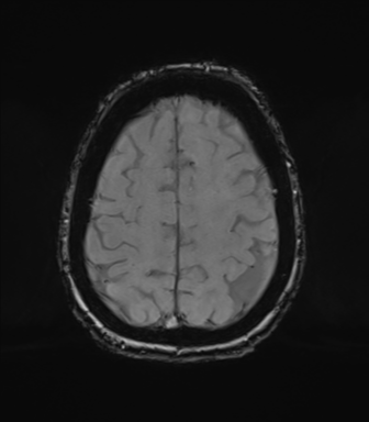 Chronic hypertensive encephalopathy (Radiopaedia 72844-83495 Axial SWI magnitude 68).png
