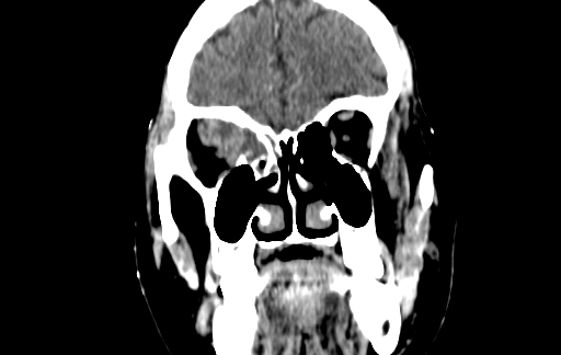 Chronic invasive fungal sinusitis (Radiopaedia 91563-109286 D 37).jpg