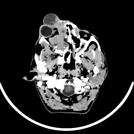 Chronic invasive fungal sinusitis with intraorbital and intracranial extension (Radiopaedia 56387-63046 B 63).jpg