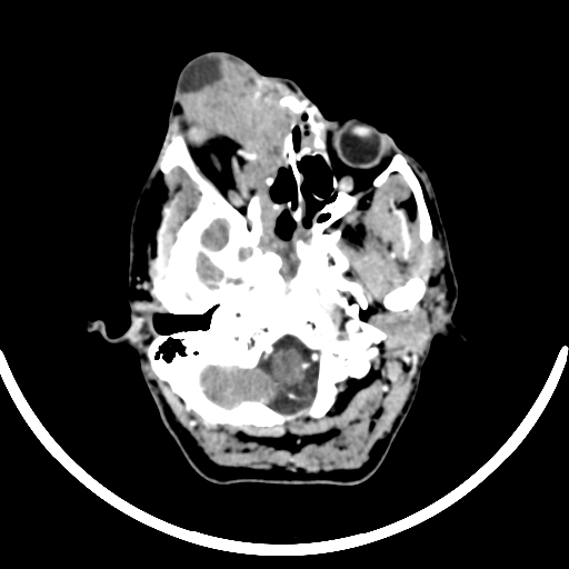 Chronic invasive fungal sinusitis with intraorbital and intracranial extension (Radiopaedia 56387-63046 B 82).jpg